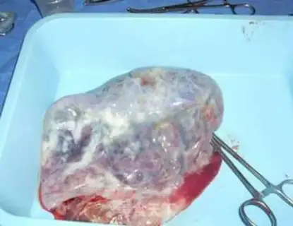 Make Fired placenta step 0